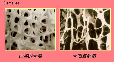 osteoporosis.jpg