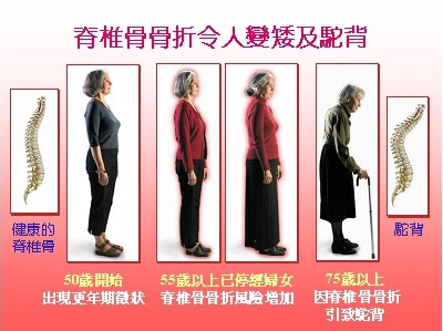 osteoporois-2.jpg
